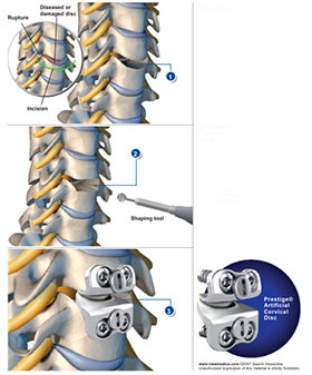 Artificial Cervical Disc Replacement Surgery - Sydney, NSW