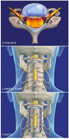 Laminectomy (Cervical) with Fusion - Sydney, NSW