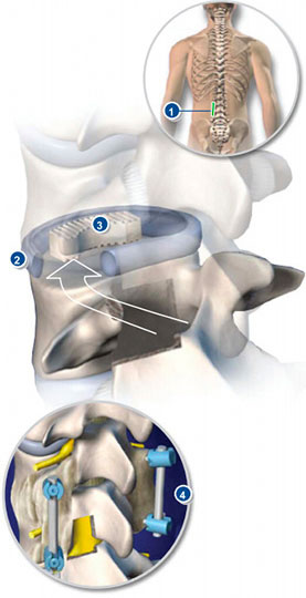 Transforaminal Lumbar Interbody Fusion - Sydney, NSW