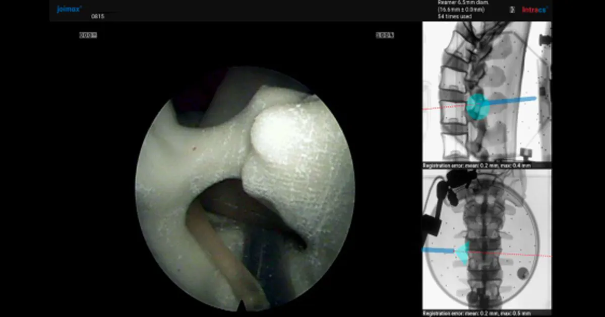 Endoscopic spine surgery