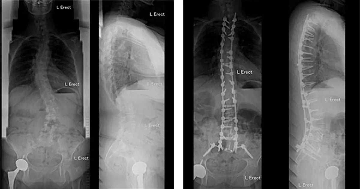 Deformity surgery is one of the more challenging procedures in spinal surgery and can account for long operative times and blood losses. To date, many strategies have been in use to attempt to reduce perioperative complications in adult deformity surgery.
