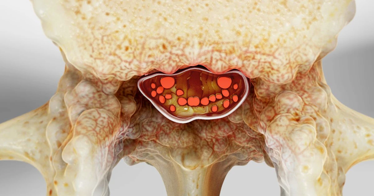 Dr Sitoula and Dr Guitarte arrived in Australia following their selection for the Macquarie University Hospital and NSW Spine Specialists complex spine fellowship. 