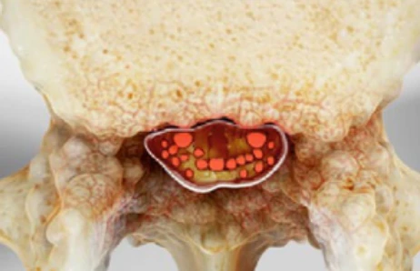 Narrowing of the spinal canal