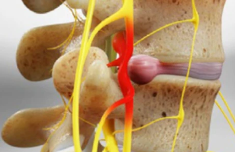 Herniated disc